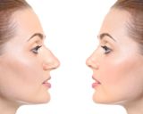 When the First Nose Job Isn't the Last: The Complete Guide to Revision Rhinoplasty