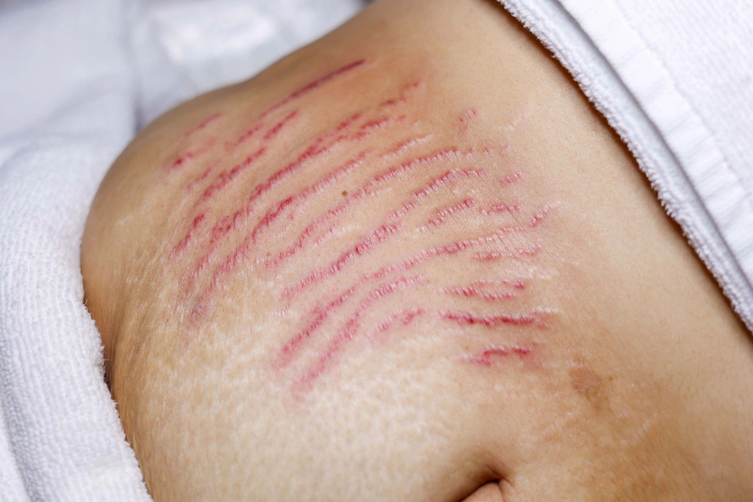 Luxury Guide to Scars: What Actually Improves Them?